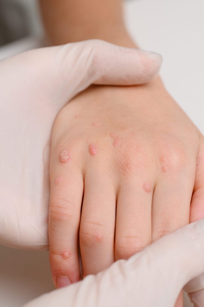 Gloved hands examining small raised warts on a child's hand