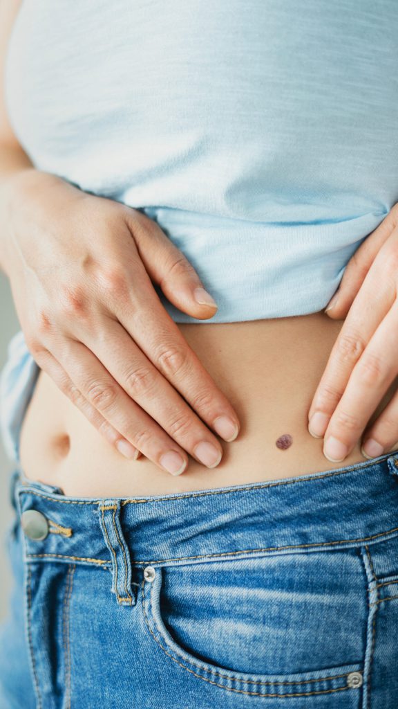 Woman's hands framing a small dark, raised spot beside her navel