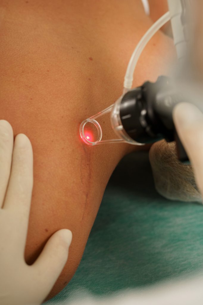 Gloved hands guiding a laser handpiece along a scar on a patient's skin