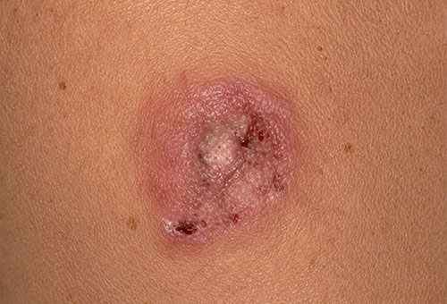 img-treatment-duringtreatment