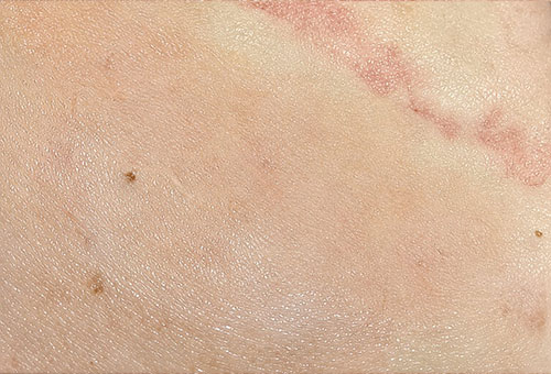 Two Months Post-Treatment