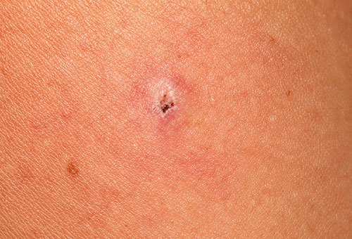 img-treatment-pretreatment